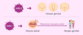 Herpes genital: ¿Cuáles son los síntomas? ¿Tiene tratamiento?