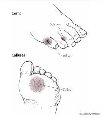 Pictures of corns on feet. Calluses And Corns Harvard Health