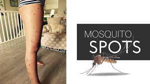 How to get rid of mosquito bite marks? How To Get Rid Of Hyperpigmentation Scars On Legs Mosquito Bites On Skin Skin Care Tretinoin Youtube