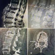 Distal radius fractures programme online course: Cureus Treatment Of A High Risk Thoracolumbar Compression Fracture Using Bilateral Expandable Titanium Spinejack Implants