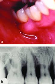 Image result for Periodontal Abscess