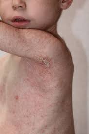 Image result for scabies human children