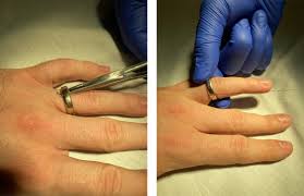 Image result for Ring Removal