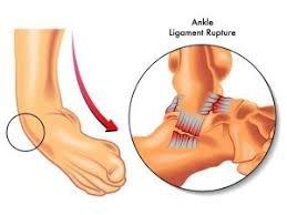 Adhesions cause pain, inflammation and restricted movement because the layers. Common Procedures Performed During Reconstructive Foot Surgery