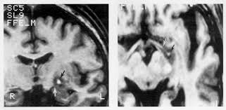 Image result for Pallidotomy