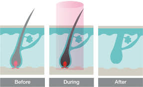 We did not find results for: Elysion Laser Hair Removal Vanite Clinic Solihull