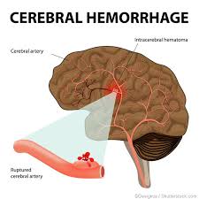 L'emorragia cerebrale, o ictus, colpisce ogni anno circa 15 milioni di persone. Emorragia Intracerebrale Ich