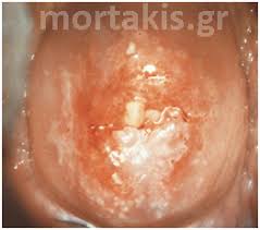 Image result for Colposcopy Findings