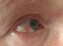 Zona zoster este o dermatoza acuta. Efectele Virusului Varicelei Zona Zoster Simptome È™i ComplicaÈ›ii Dcmedical Ro