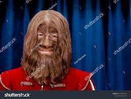 Image result for Hypertrichosis