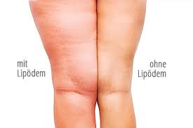 Lipodem Park Klinik Birkenwerder Bei Berlin
