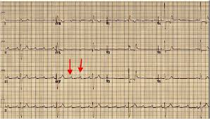 Image result for Atrioventricular Block