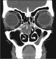 Scielo Brasil Typical And Atypical Presentations Of Paranasal Sinus Mucocele At Computed Tomography Typical And Atypical Presentations Of Paranasal Sinus Mucocele At Computed Tomography
