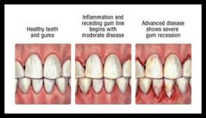 Diagram Showing Healthy Teeth And Gums To Advanced