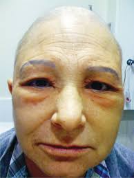 Should i see a doctor? Pemetrexed Induced Fluid Retention Journal Of Thoracic Oncology