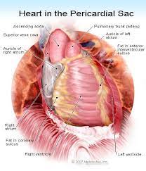 Myocarditis is an inflammation of the heart muscle and can be caused by a variety of infections, conditions, and viruses. Pericarditis Effusion Symptoms Ecg Causes Treatments