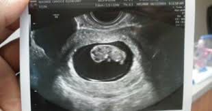 Transv Ultrasound 9weeks 4 Days Due January 11 2016 Ultrasound Pictures 10 Week Ultrasound Pictures 9 Week Ultrasound