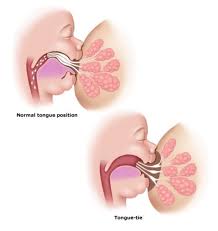Feb 15, 2014 · if the frenulum is tight, it will often turn white or blanch. Tongue Tied Infants My Process For Determining If Your Baby Has A Tongue Tie And Needs A Lingual Frenectomy Dr Chelsea Pinto Los Angeles Infant Tongue Tie Specialist