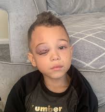 I was told my son's sore eye was just hay fever
