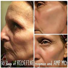 Speed up your RF results with the Amp Roller!! It's done wonders for my own  skin and I would recommend it to anyone in a heartbeat!! It can also help  fill in