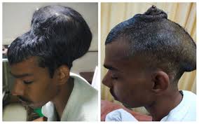 • the tumor is benign, meaning it's not cancer, but it's still pressing on the brain or the tumor is malignant, which means that it is cancer. This Man S Brain Tumor Was So Big That It Sat Like A Head On Top Of Another Head The Washington Post