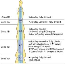 The fds to the middle finger is tested by holding the other 3 fingers in full extension, thereby immobilizing the fdp (shown in black). Primary Flexor Tendon Repair With Early Active Motion Hand Clinics