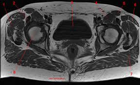 Anatomic relationship between the vaginal apex and the bony architecture of the pelvis: Mri Of The Hip Detailed Anatomy W Radiology