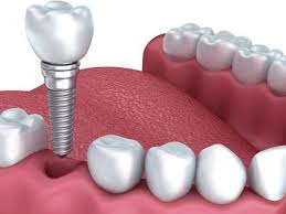 7 kinh nghiệm trồng răng Implant quan trọng bạn nên biết