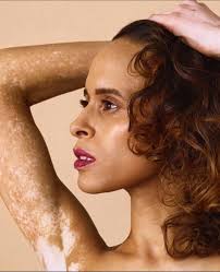 The Vitiligo Society