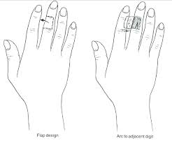 fingertip utations finger flaps