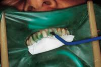 Follow a simplified process in veneer cementation. Final Cementation Of Porcelain Veneers Dentistry Today