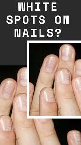 White Spots On Nails In 2020 White Spots On Nails Nails White Spot