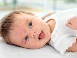 However, some continue to be allergic to milk until they are. Dairy Overload Dairy Intolerance And Dairy Allergy Cmpa