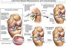 This flap can provide a versatile source of vascularized bone with limited donor site morbidity and requires minimal time for flap harvest. Cpt Code 29881 29880 And 29877 Coding Guide