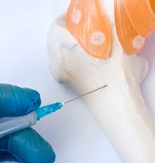 Image result for Bone Marrow Exam