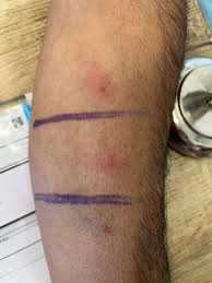 Image result for Pathergy