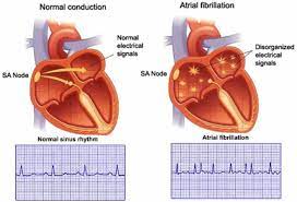 Arrhythmia, also known as cardiac arrhythmia or heart arrhythmia, is a group of conditions in which the heartbeat is irregular, too fast, or too slow. Know About Cardiac Arrhythmia Irregular Heartbeat