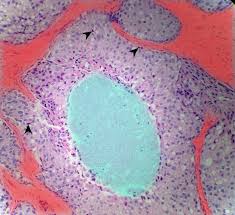 New lump in the breast or underarm (armpit) thickening or swelling of part of the breast irritation or dimpling of breast skin Breast Cancer Amboss