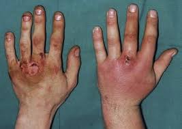 Image result for Hand Infection
