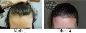 Women who are predisposed to hormonal related hair loss or who are hypersensitive to the hormonal changes taking place in their bodies can experience hair loss to varying degrees while on the pill or more commonly, several weeks or months after stopping the pill. Postpartum Hair Loss Treatment