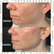 Radiesse filler in the cheeks, jaw and chin ➡️ UNDENIABLE structure,  balance and contour! 😍 🍀 Remember, a good injector is like a four leaf  clover, and we're lucky to have 3