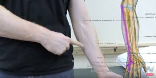 Ulnar tunnel syndrome occurs when the ulnar nerve becomes compressed in the guyon's canal region. Ulnar Nerve Entrapment Physical Therapy 101