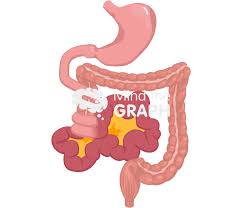 Image result for Midgut Volvulus