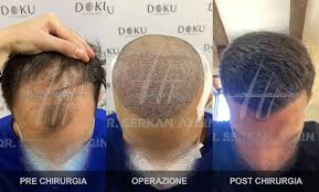 Gonfiore intorno al viso e principalmente intorno agli occhi può capitare raramente per un alcuni giorni post intervento. Dr Serkan Aygin Trapianto Capelli Turchia