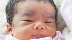 Image result for sweat rash on back baby