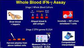 These must be followed to minimize indeterminate results. Understand The Significance Of Quantiferon Tb Gold Test