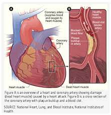 Heart and artery diseases have been presently the number one health problem in the world. Coronary Heart Disease Linus Pauling Institute Oregon State University