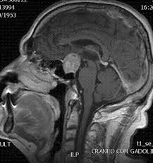 Tumor Pituitari / Adenoma Hipofise / Tumor Hipofisis