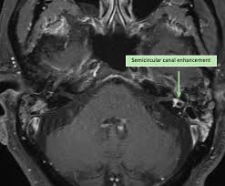 Image result for Bacterial Labyrinthitis
