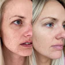 See the ordinary peeling solution before and after pictures and reviews. Skin Guide Skincity Com